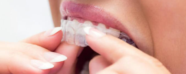 Invisalign